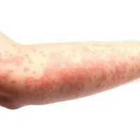 Rash on arm indicative of a COVID 19 rash.